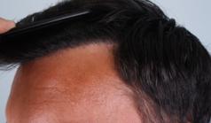 Before Hair Transplant&nbsp;Front